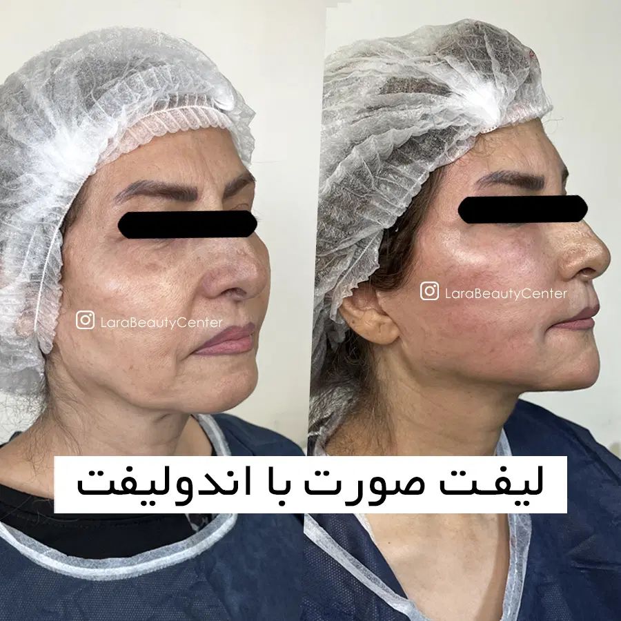 جوانسازی لیفت صورت اندولیفت هایفو تخفیف ویژه|خدمات آرایشگری و زیبایی|تهران, صادقیه|دیوار