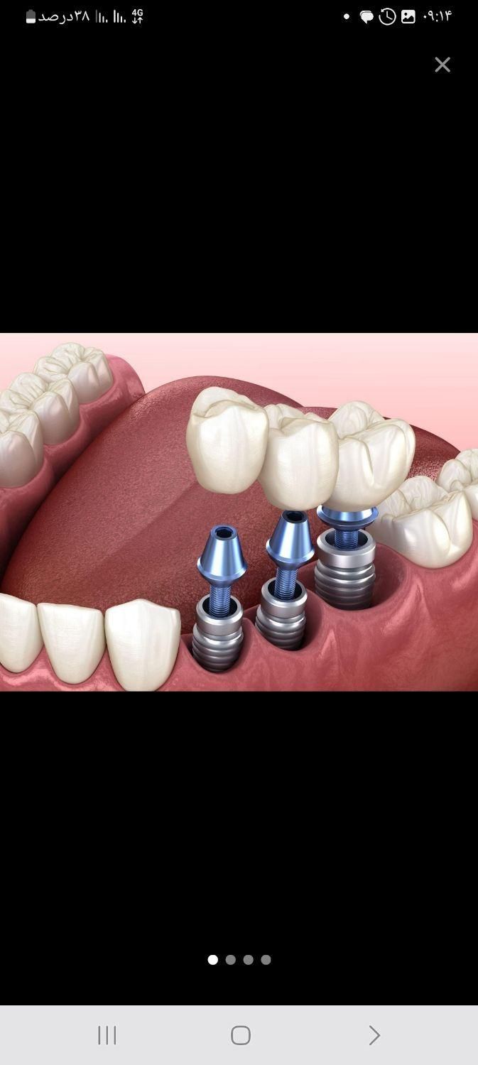ایمپلنت (دندان ثابت) با بالاترین کیفیت وقیمت خیریه|خدمات آرایشگری و زیبایی|زاهدان, |دیوار