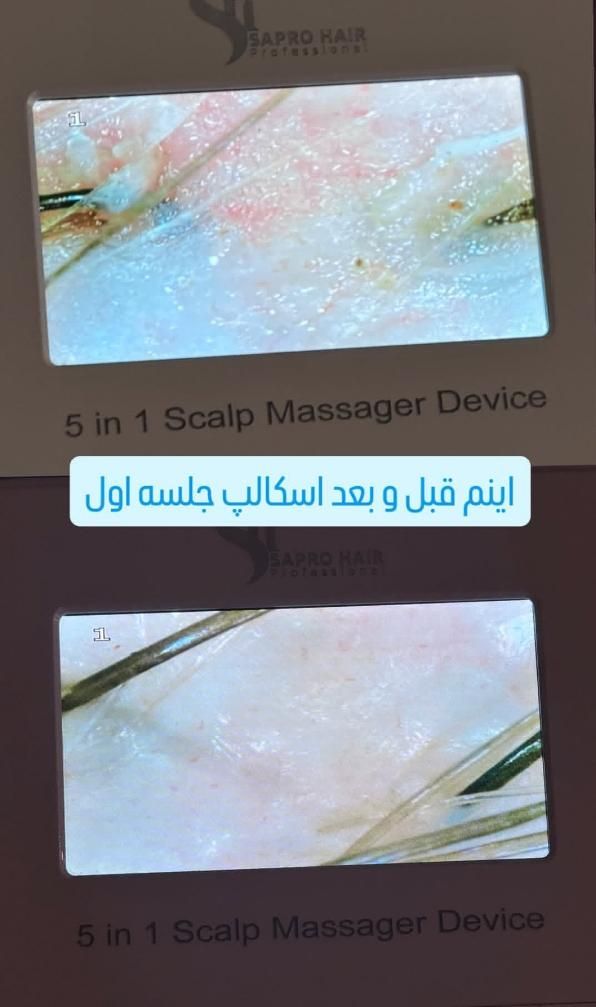 پاکسازی تخصصی کف سر + آنالیز رایگان +تخفیف بینظیر|خدمات آرایشگری و زیبایی|رودهن, |دیوار