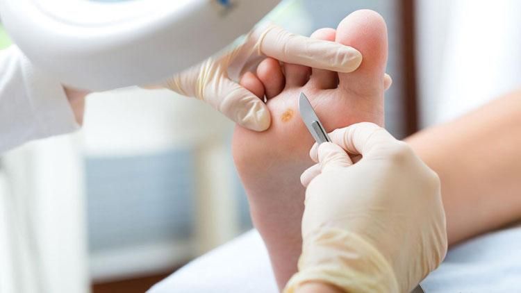 زگیل برداری میخچه برداری و...|خدمات آرایشگری و زیبایی|ارومیه, |دیوار