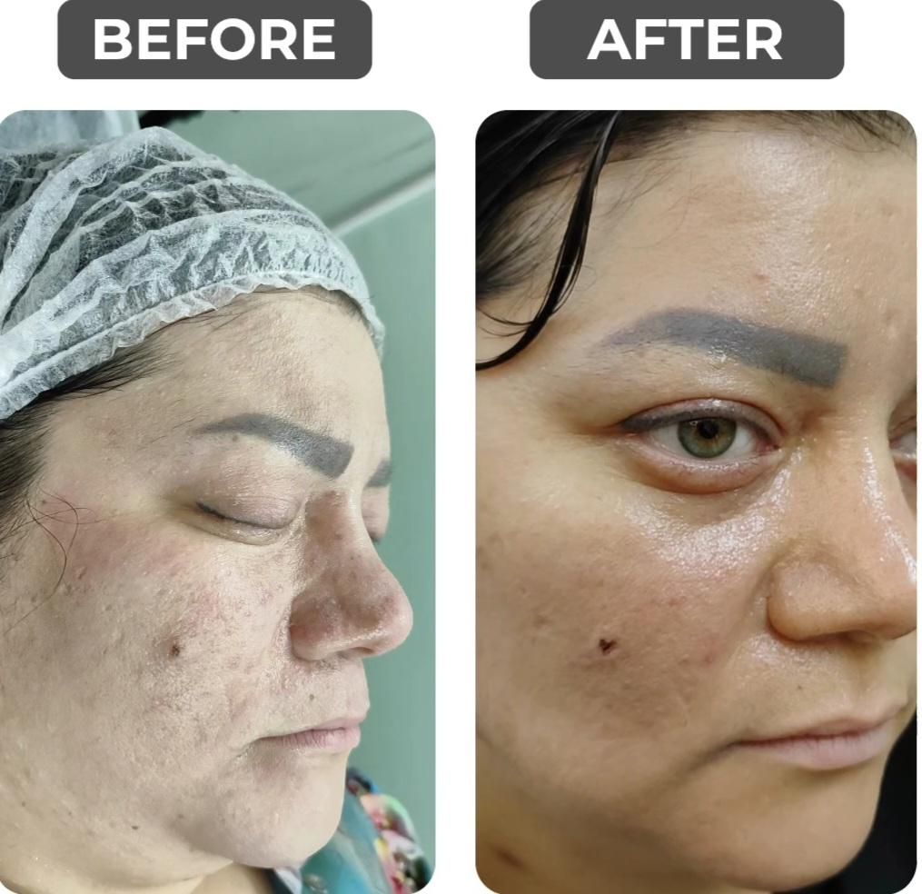 پاکسازی،مزونیدلینگ،برداشتن کک ومک،پیرسینگ+آموزش|خدمات آرایشگری و زیبایی|مشهد, سجاد شهر|دیوار