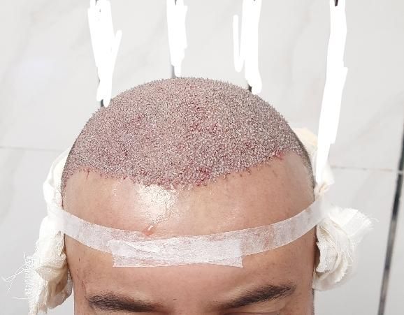 کاشت تخصصی مو و ریش،مزوتراپی،prp(تضمینی)|خدمات آرایشگری و زیبایی|اصفهان, سعادت‌آباد|دیوار
