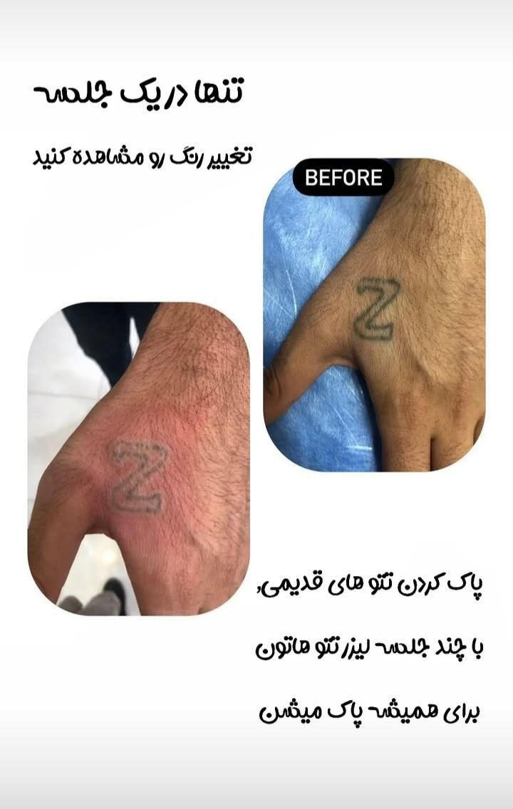 رفع تیرگی بدن  و لیزر تتوهای قدیمی بدن و صورت|خدمات آرایشگری و زیبایی|یاسوج, |دیوار