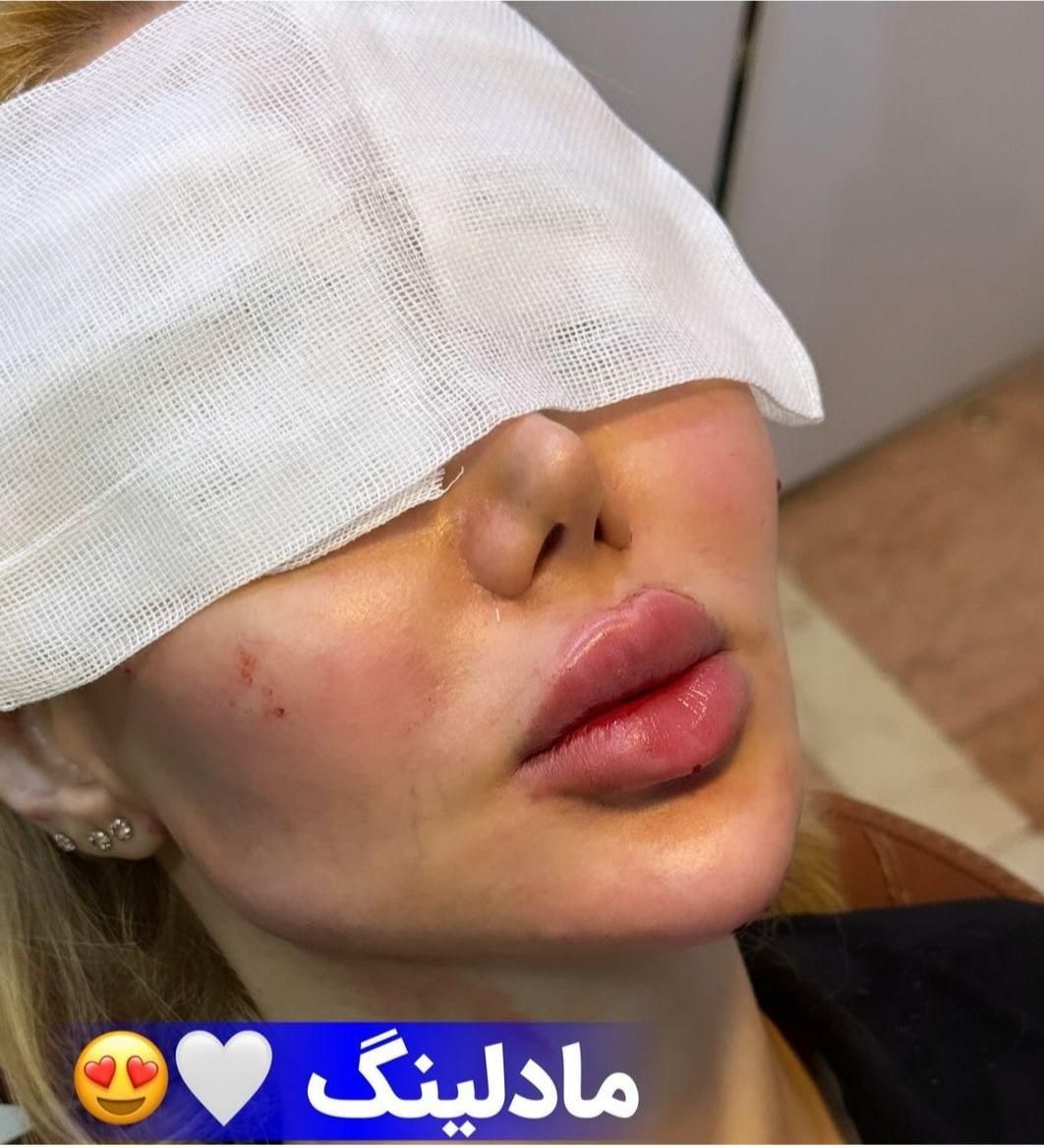 ژل بوتاکس فیلر چربی مزو جوانساز بلفارو درمطب پزشک|خدمات آرایشگری و زیبایی|کرج, گوهردشت|دیوار