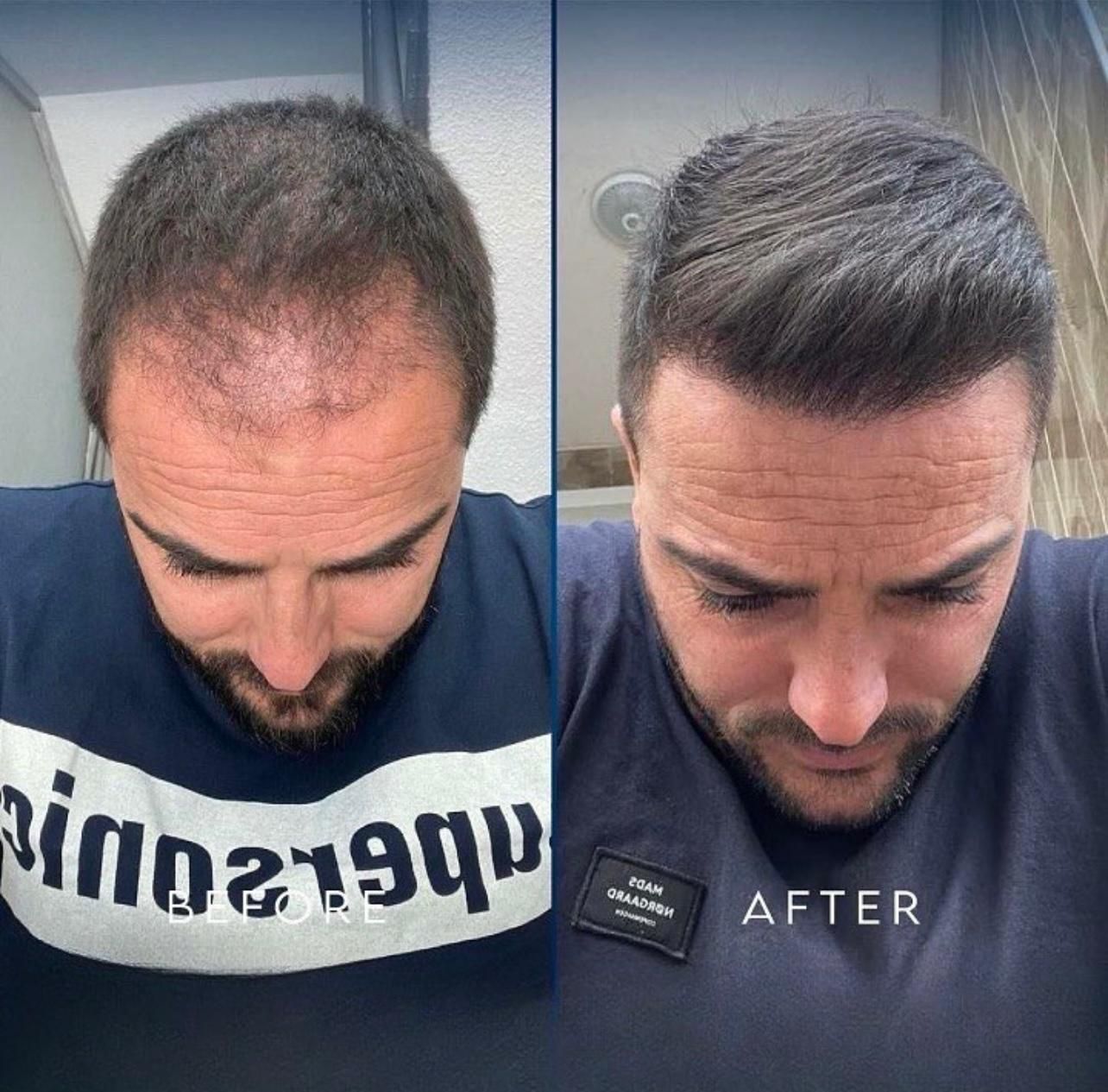 کاشت مو با جدید ترین تکنیک|خدمات آرایشگری و زیبایی|دزفول, |دیوار