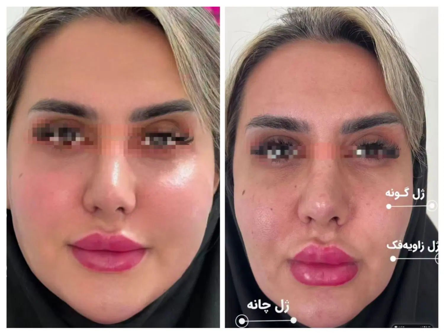 مرکز تخصصی فرم دهی و‌لیفت بینی و صورت با نخ و‌ژل|خدمات آرایشگری و زیبایی|مشهد, احمدآباد|دیوار