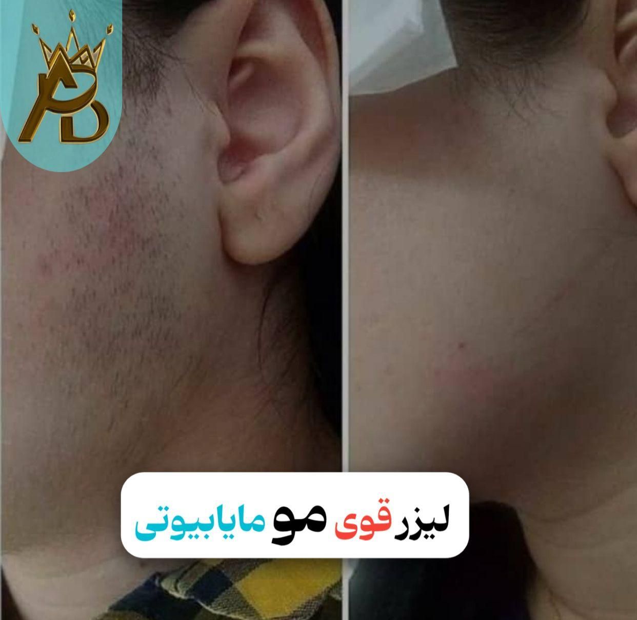 لیزر مو زائد مادام العمر و تضمینی مایا بیوتی|خدمات آرایشگری و زیبایی|یاسوج, |دیوار