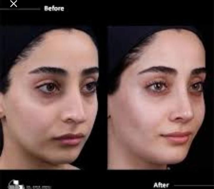 جراحی بینی.صورت.لیفت.پیکرتراشی|خدمات آرایشگری و زیبایی|کرج, گلشهر|دیوار