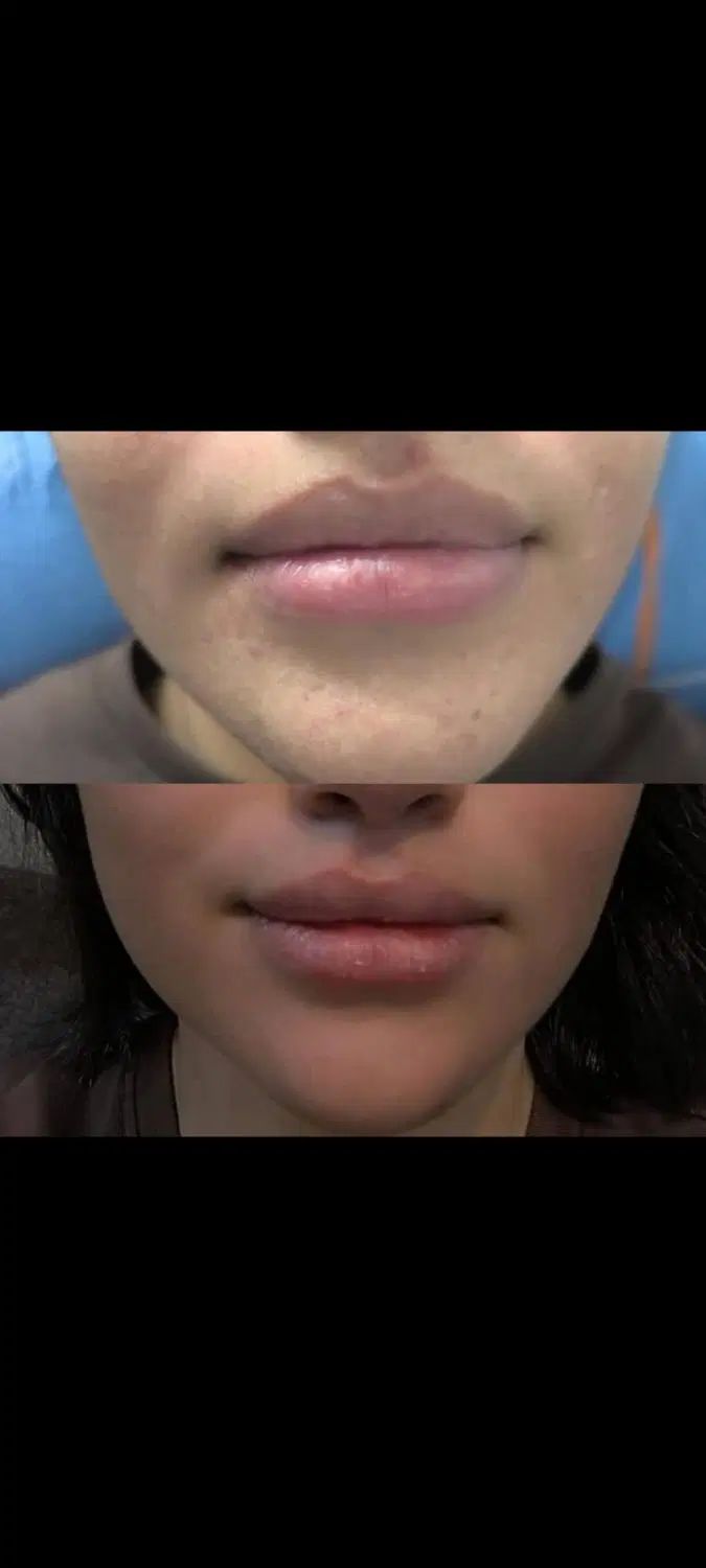 اموزش و خدمات بوتاکس و فیلروفیشیال و فیلر بادی|خدمات آرایشگری و زیبایی|شیراز, کوشک میدان|دیوار