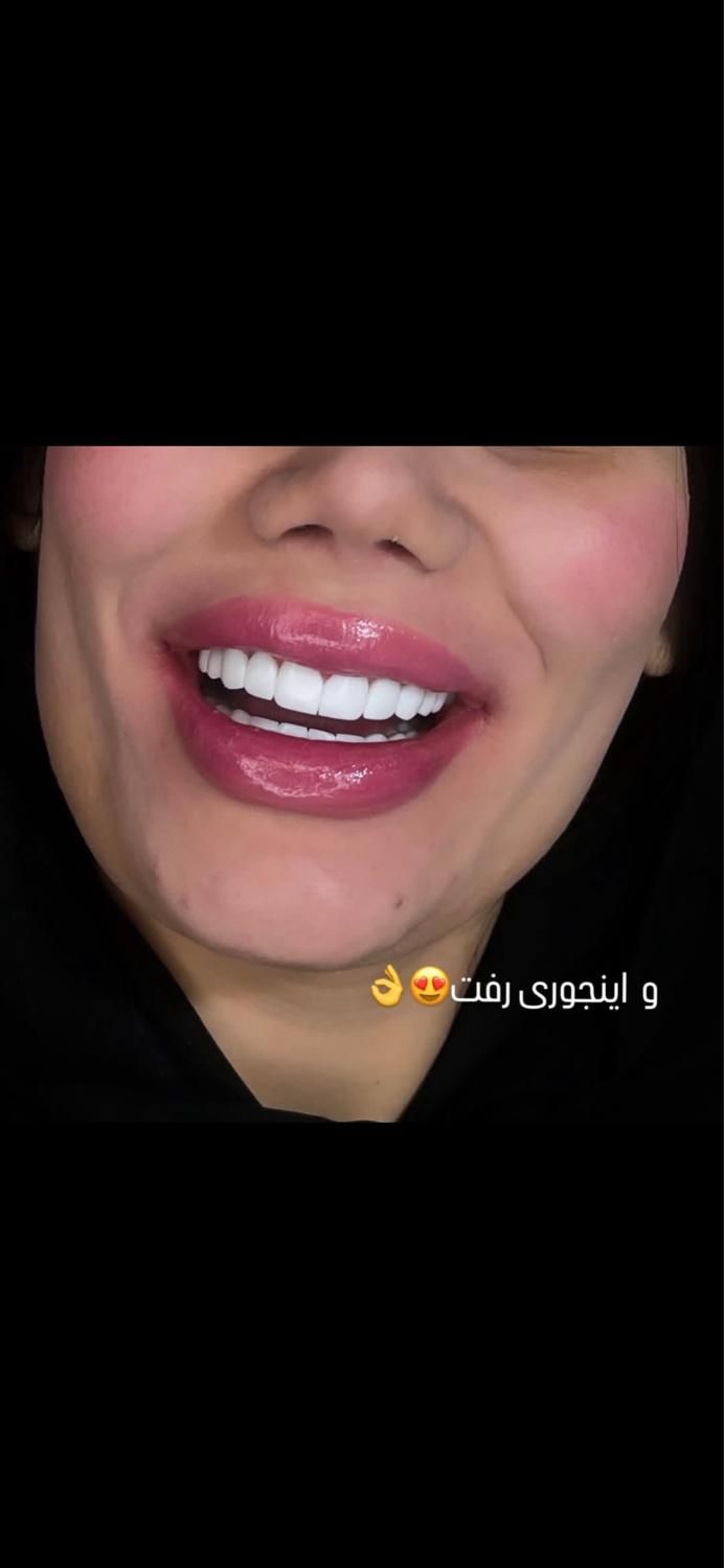کامپوزیت دندان|خدمات آرایشگری و زیبایی|اهواز, نادری|دیوار