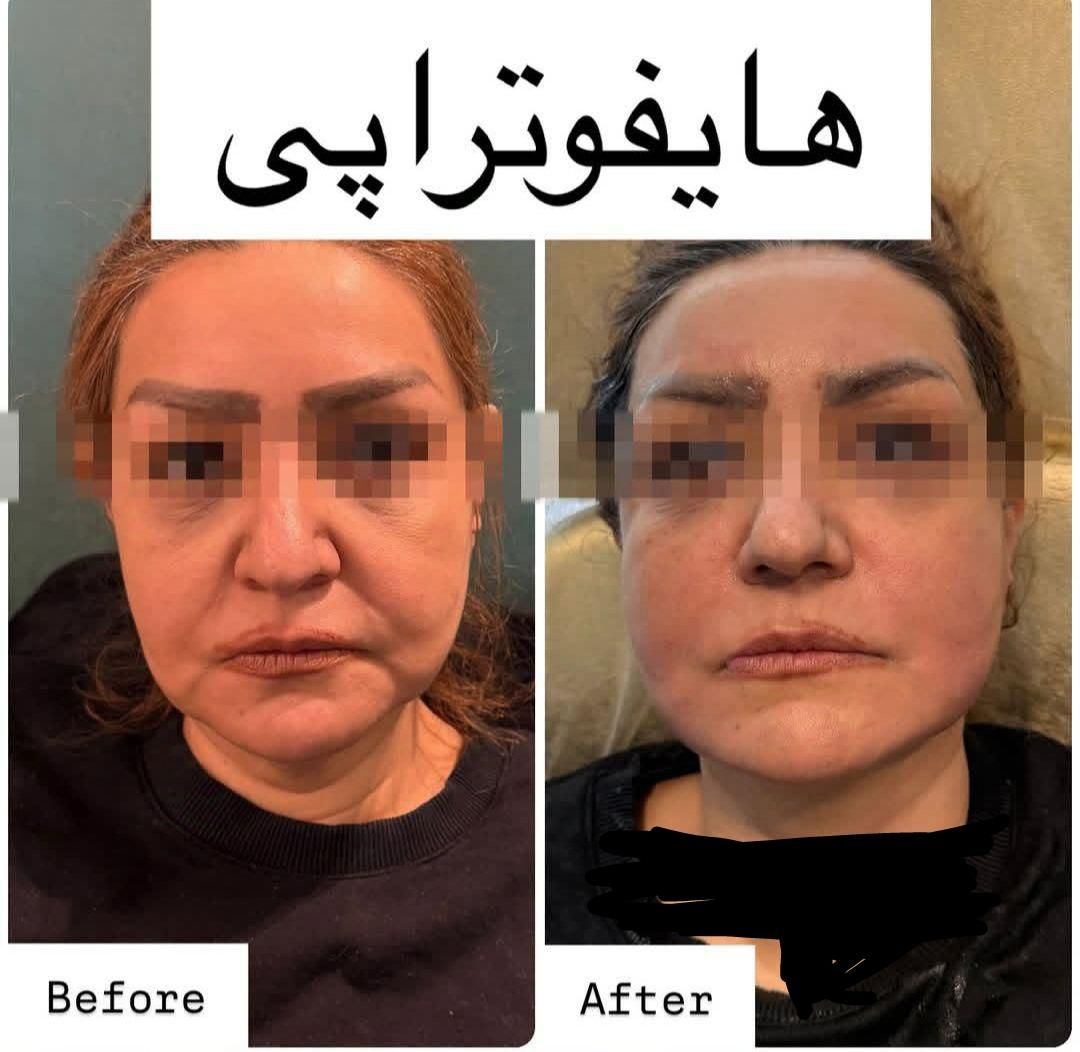 هایفوتراپی جوانسازی آف ویژه|خدمات آرایشگری و زیبایی|قم, شهرک قدس|دیوار