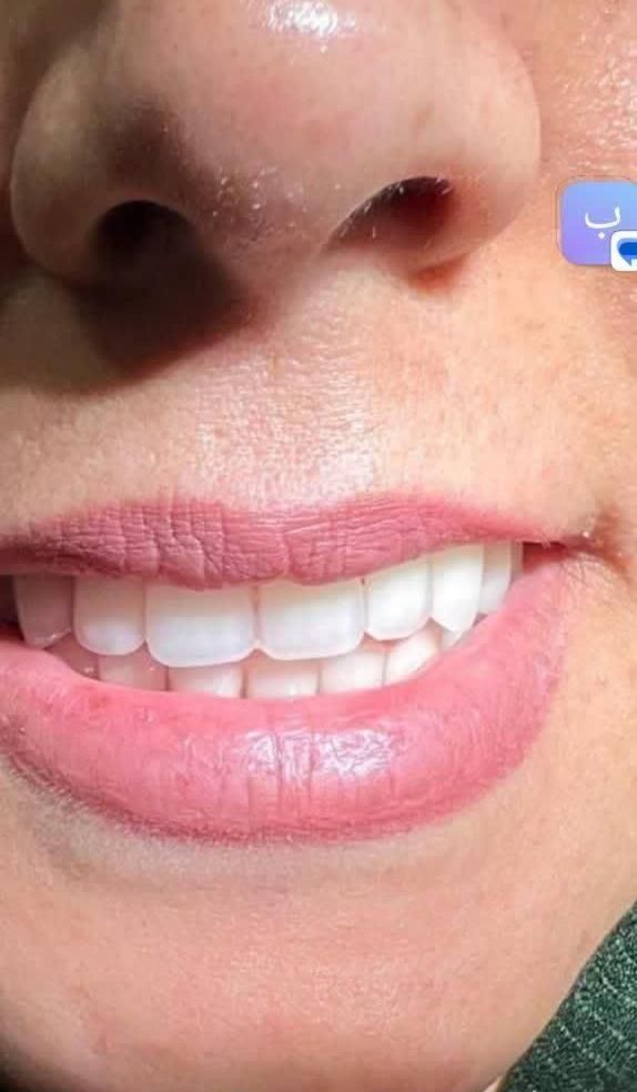 دندان سرامیکی طرح لمینت تحویل چندساعته|خدمات آرایشگری و زیبایی|محلات, |دیوار