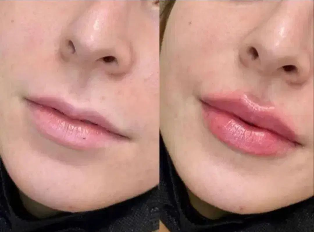 تزریق ژل .بوتاکس .انزیم بینی .مزوژل جوانساز|خدمات آرایشگری و زیبایی|جهرم, |دیوار