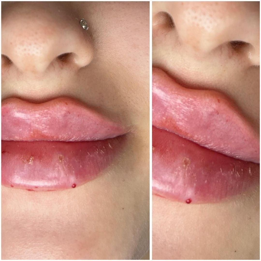 جشنواره تزریق فیلر مدت محدود فقط ۷۸۰ تومن|خدمات آرایشگری و زیبایی|زنجان, |دیوار