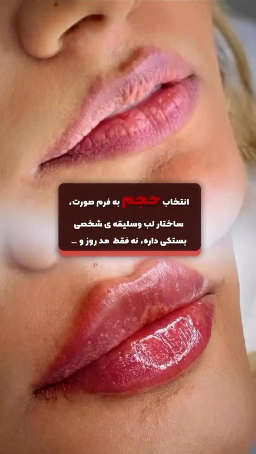 خدمات تزریقات فیلر(ژل)وبوتاکس باپترووآزاد|خدمات آرایشگری و زیبایی|بندر ماهشهر, |دیوار