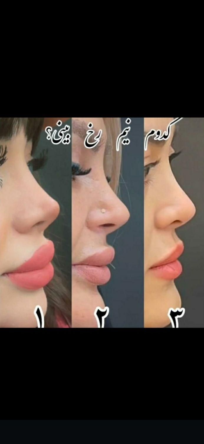 جراحی بینی  لیپوماتیک  پروتز سینه ابدو مامو لیفت|خدمات آرایشگری و زیبایی|اصفهان, مرداویج|دیوار