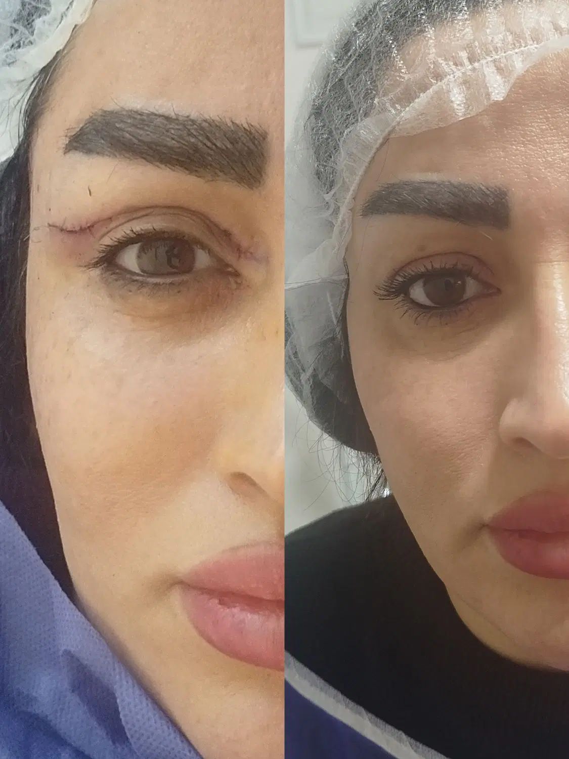 جراحی بلفارو پلاستی ساکشن غبغب بوکال فت سانترال .|خدمات آرایشگری و زیبایی|کرج, فاز ۳ مهرشهر|دیوار