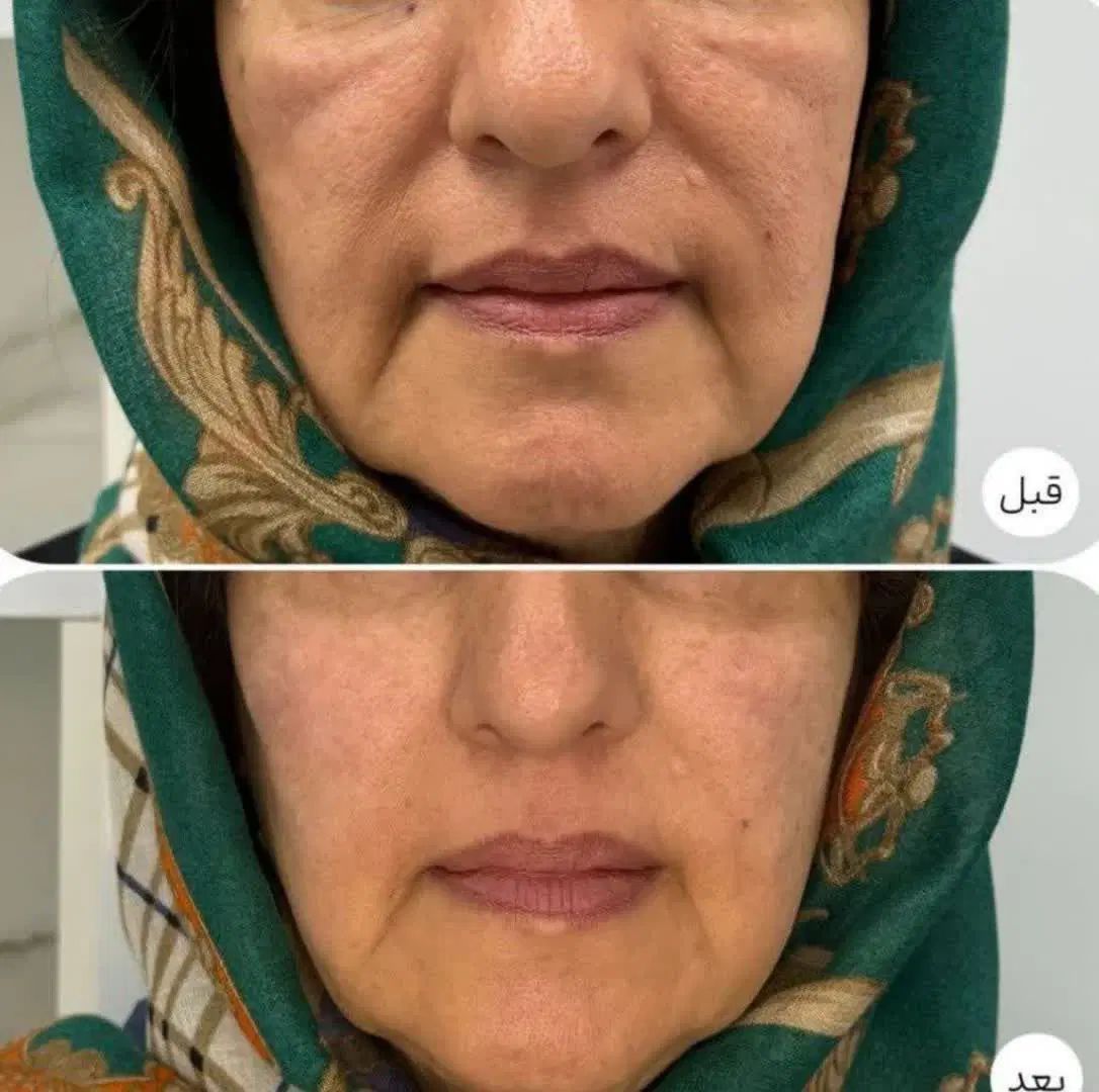 کرم گلدن کوین دفع کک ومک ولک و جای جوش اصلی|آرایشی، بهداشتی، درمانی|کرمانشاه, |دیوار
