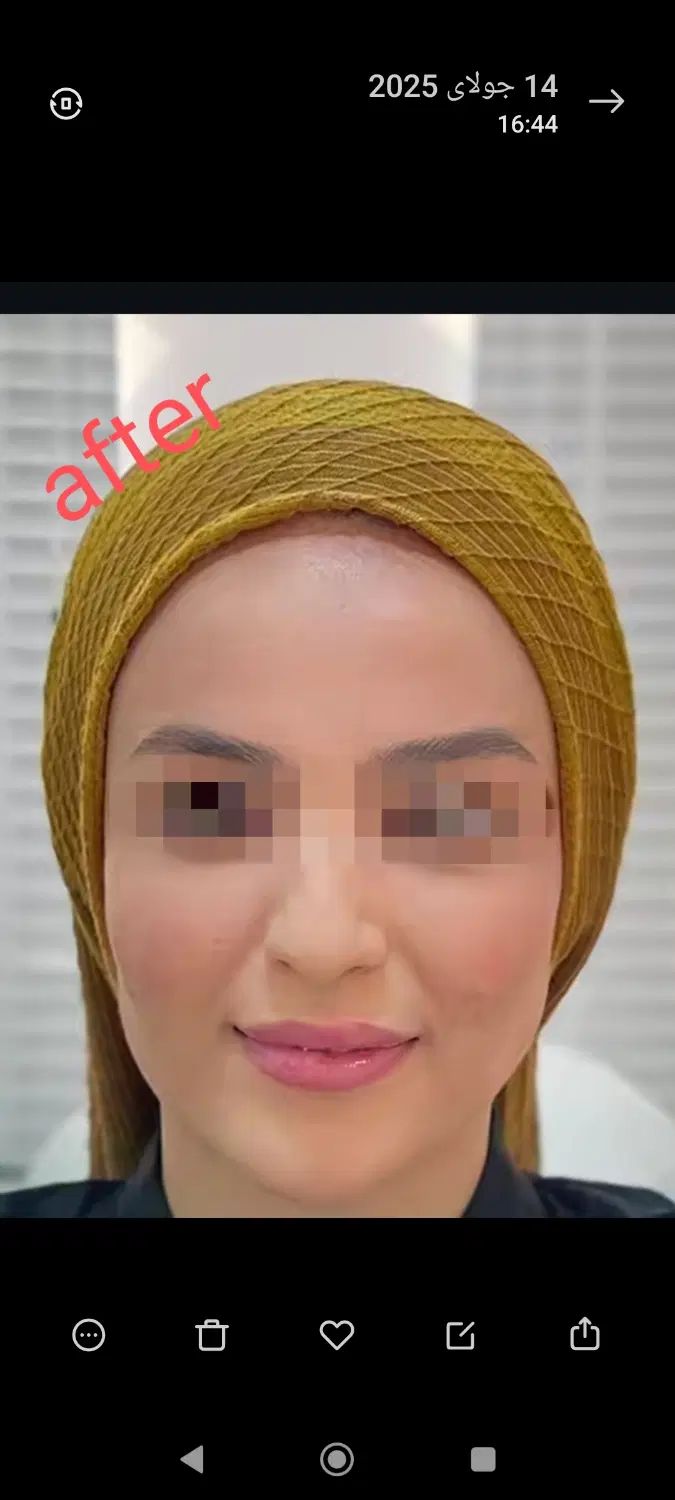 بوتاکس رایگان با انجام دو سی سی فیلر پیروزی|خدمات آرایشگری و زیبایی|تهران, چهارصد دستگاه|دیوار