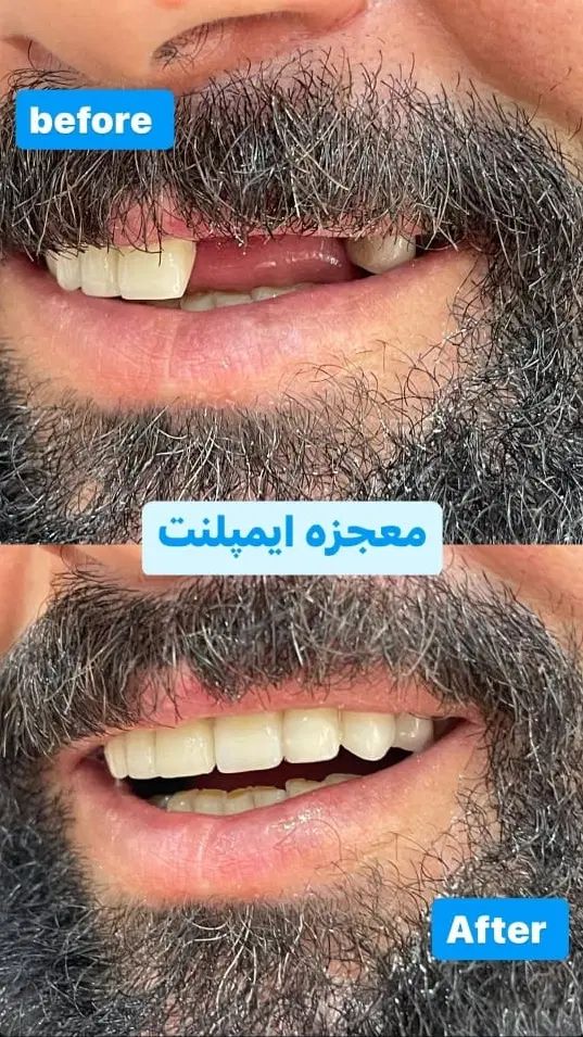 ۱۵درصد تخفیف روی خدمات ایمپلنت به مدت محدود|خدمات آرایشگری و زیبایی|تبریز, |دیوار