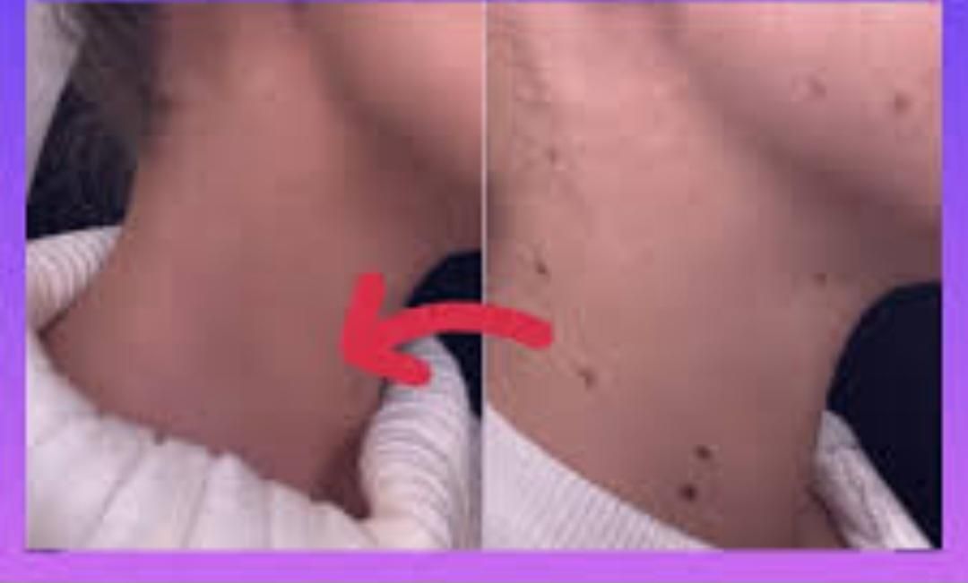 برداشتن انواع خال وزیگل با دستگاه لیزر پیشرفته|خدمات آرایشگری و زیبایی|ارومیه, |دیوار