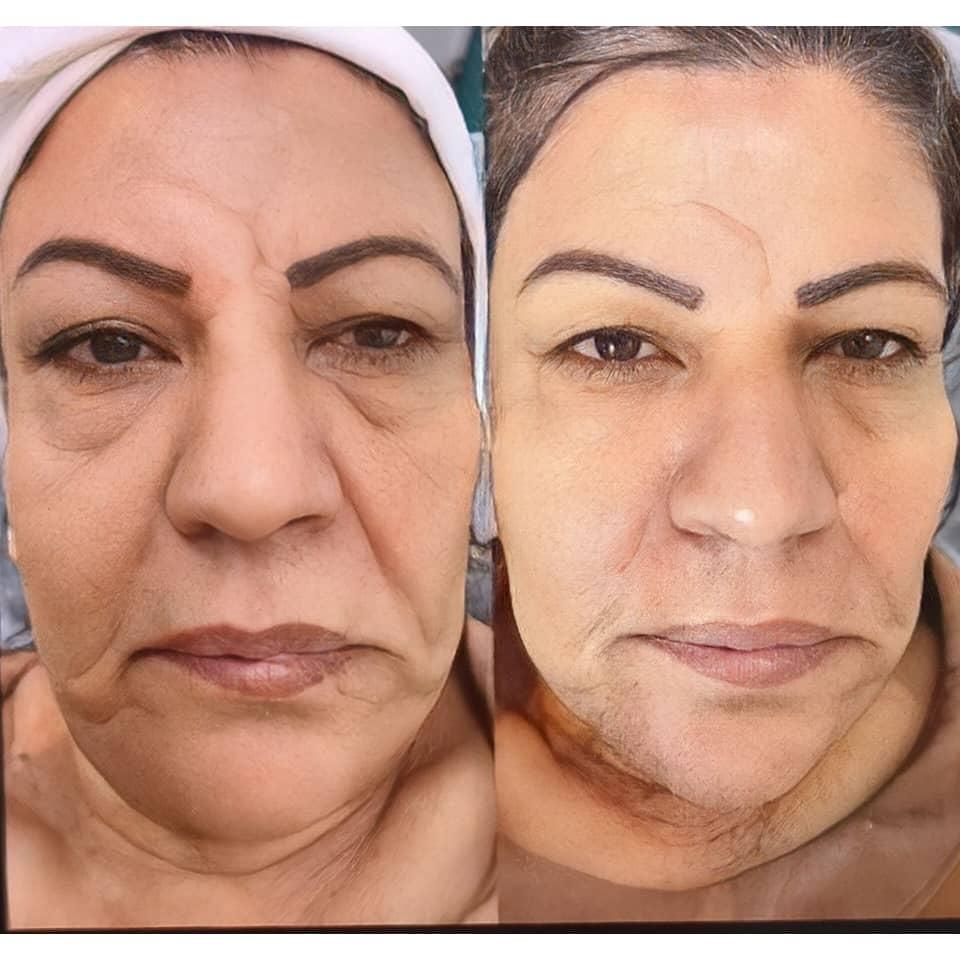 اندولیفت/ جوانسازی /تخلیه چربی صورت / رفع سلولیت|خدمات آرایشگری و زیبایی|تهران, صادقیه|دیوار