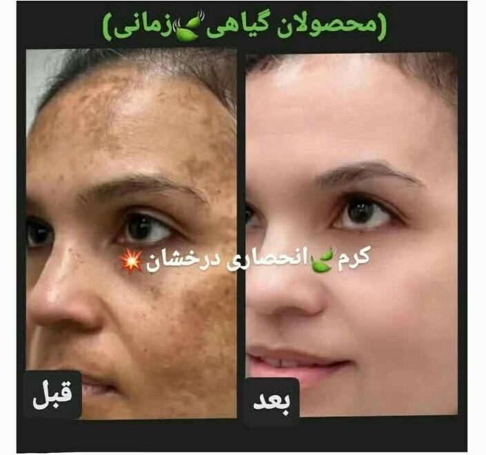 (کرم ضدلک و روشن کننده درخشان)بدون بازگشت|آرایشی، بهداشتی، درمانی|شیراز, قصرالدشت|دیوار