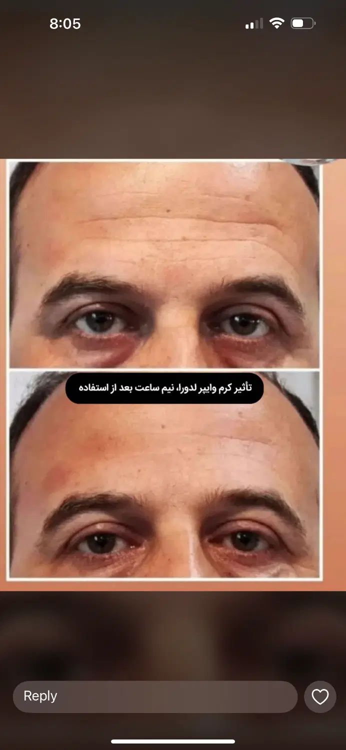 لیفت وایپر|آرایشی، بهداشتی، درمانی|تهران, شهرک محلاتی|دیوار