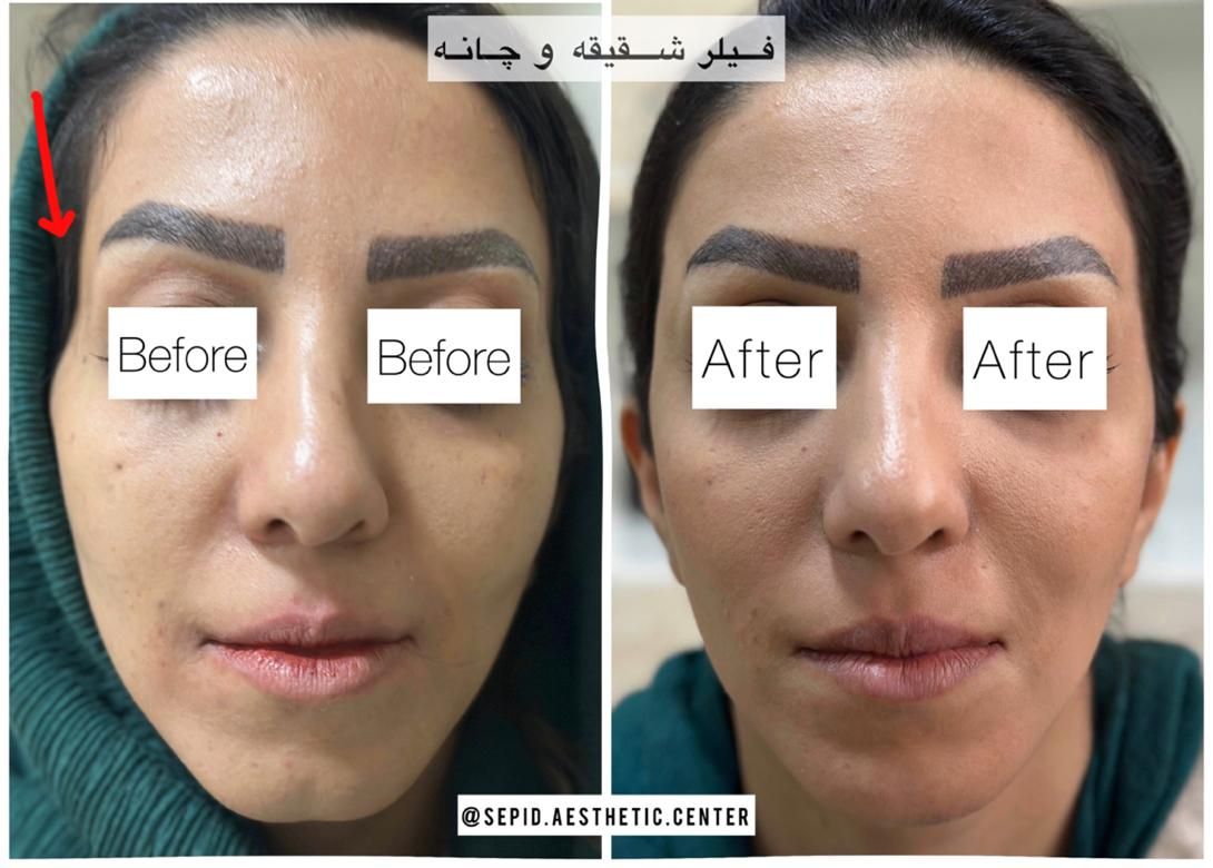 بوتاکس‌ ژل فیلر مزو خالبرداری‌ کرایو‌ وهایفو ولیزر|خدمات آرایشگری و زیبایی|تبریز, |دیوار