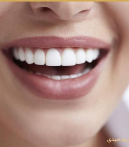 تخفیف ویژه بهترین برندهای ایمپلنت|خدمات آرایشگری و زیبایی|شیراز, زرگری|دیوار