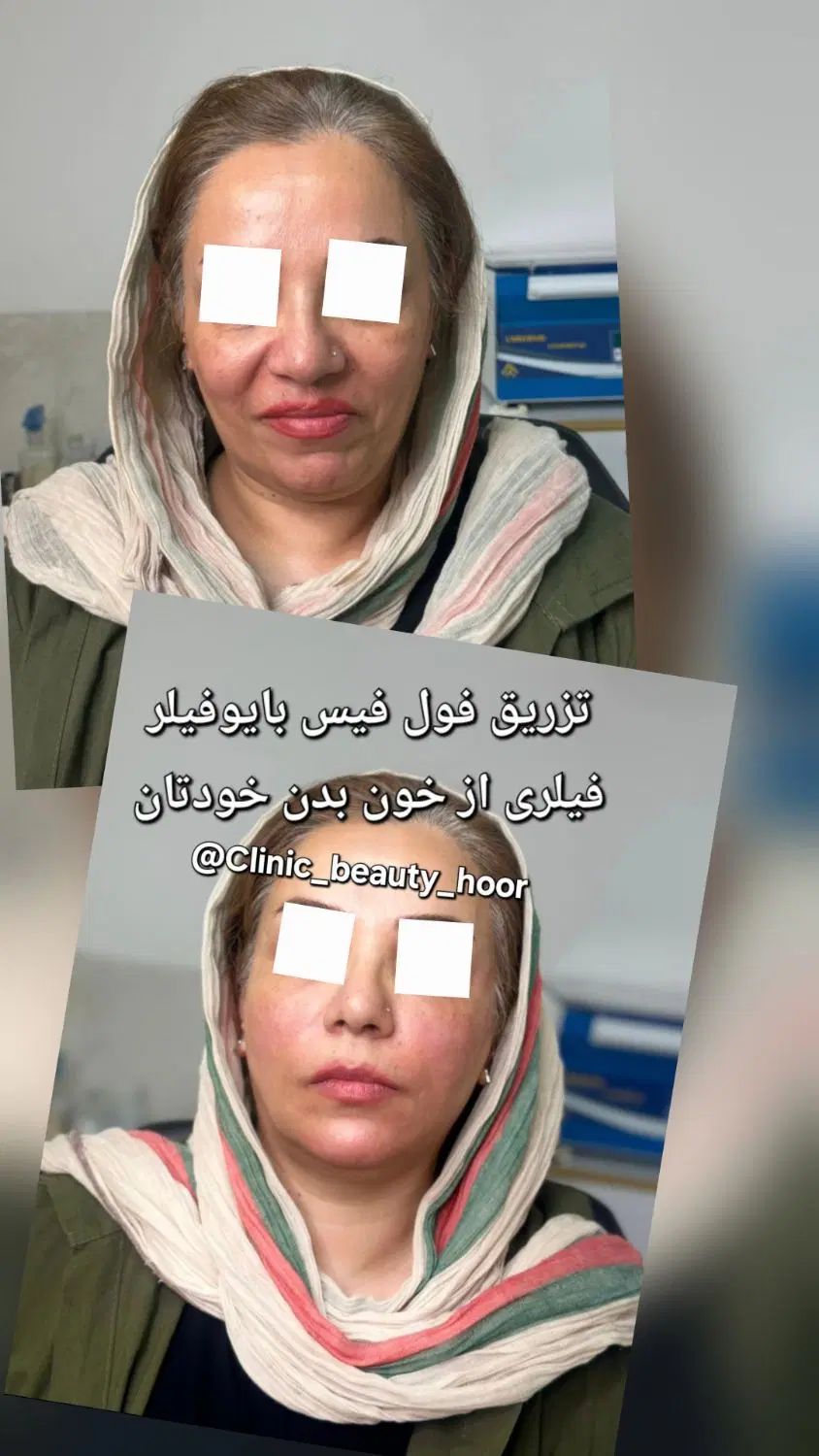کلینیک زیبایی گلد( فیلر ژل بوتاکس) توسط پزشک|خدمات آرایشگری و زیبایی|سنندج, |دیوار