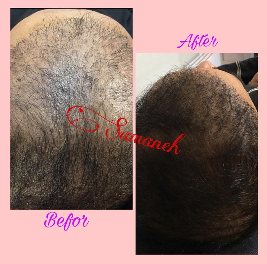 بوتاکس،ژل،چربی،ساکشن غبغب،آموزش سابسیژن پی ارپی|خدمات آرایشگری و زیبایی|اصفهان, شاهزید|دیوار