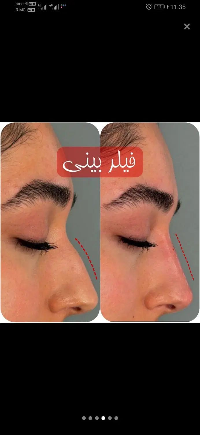 جشنواره کلینیک زیبایی / بوتاکس فیلر مزو ژل لب روسی|خدمات آرایشگری و زیبایی|مشهد, هنرستان|دیوار