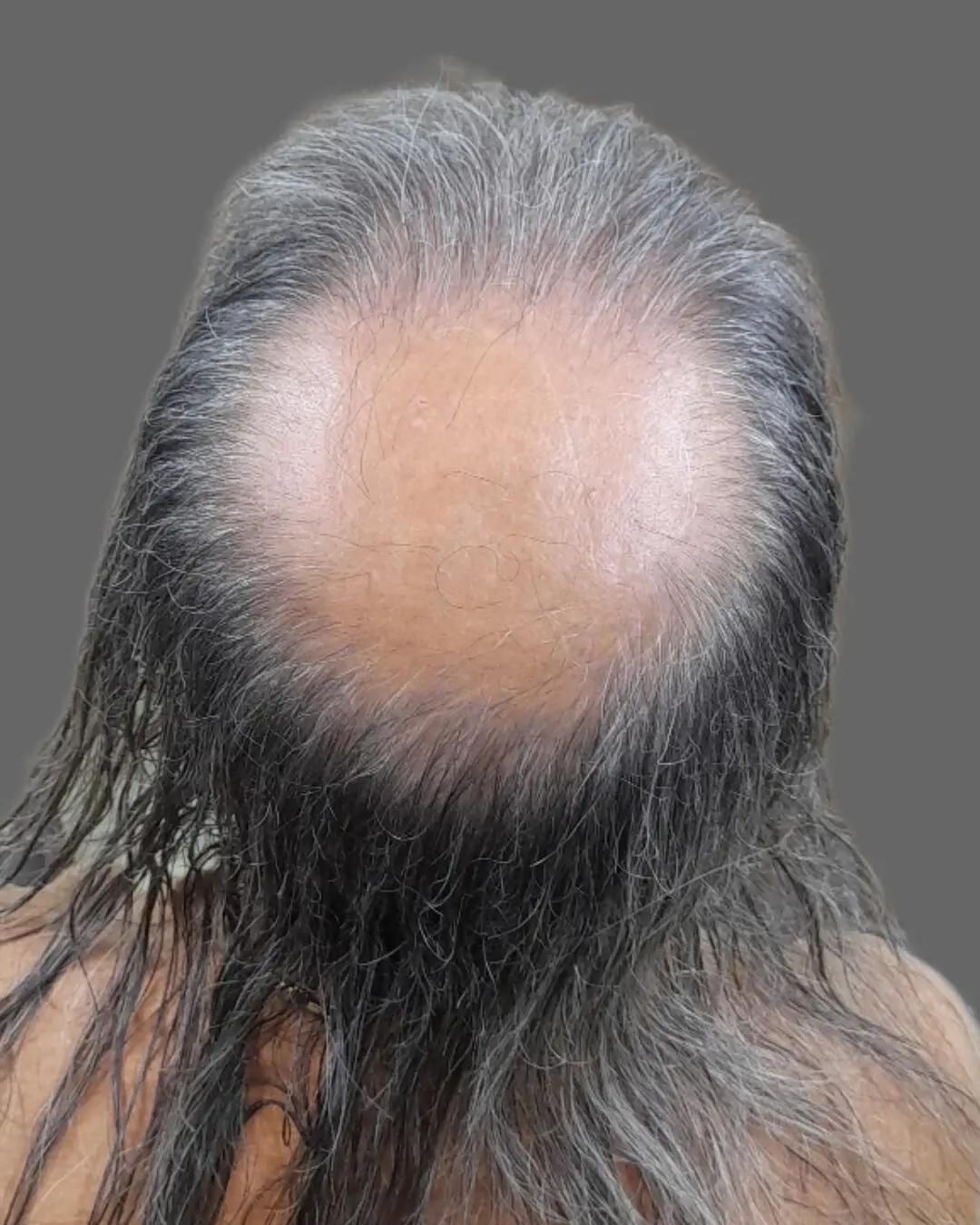 میکرواسکالپ|خدمات آرایشگری و زیبایی|رشت, گلسار|دیوار