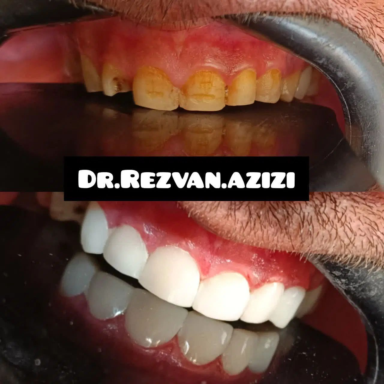 جشنواره بزرگ عصبکشی دندان برای اولین بار|خدمات آرایشگری و زیبایی|شیراز, سینما سعدی|دیوار