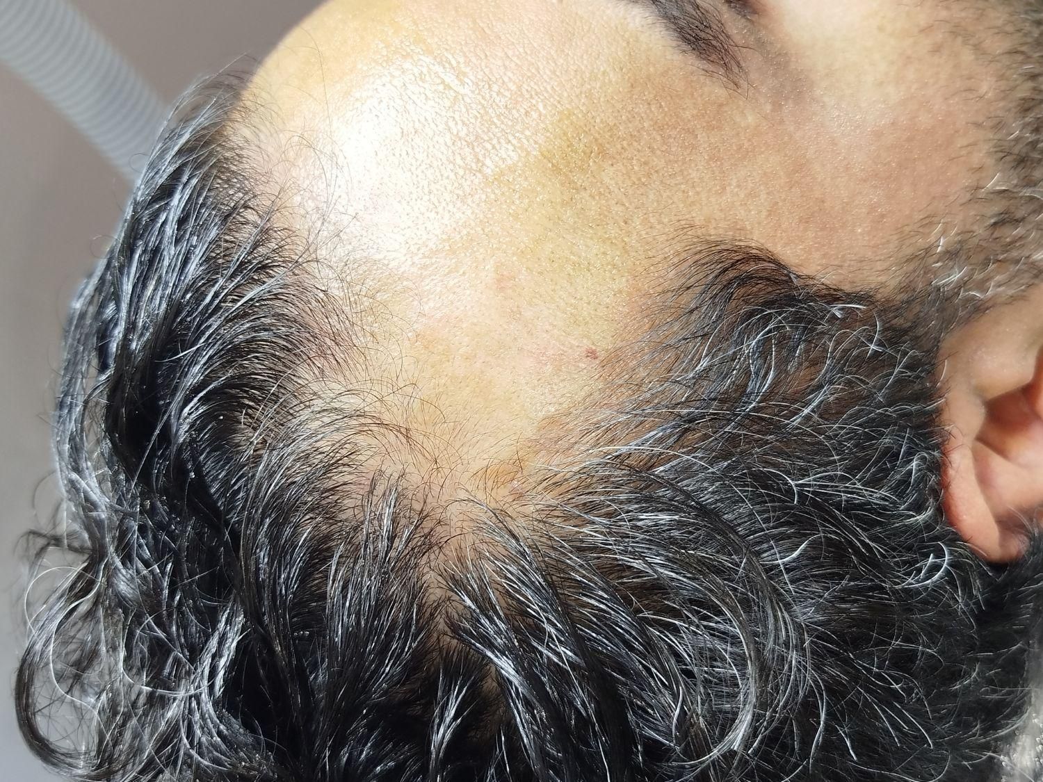 درمان ریزش مو|خدمات آرایشگری و زیبایی|رشت, بلوار گیلان|دیوار