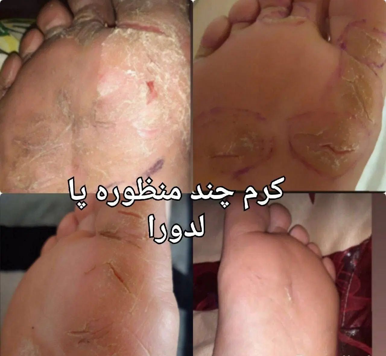 کرم ترک پای قوی لدورا ترمیم سریع ترک و خشکی|آرایشی، بهداشتی، درمانی|شاهرود, |دیوار