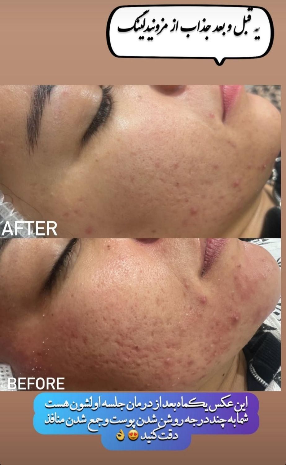 مرکز مشاوره و خدمات پوستی پاکسازی و فیشیال|آرایشی، بهداشتی، درمانی|قم, زنبیل آباد|دیوار