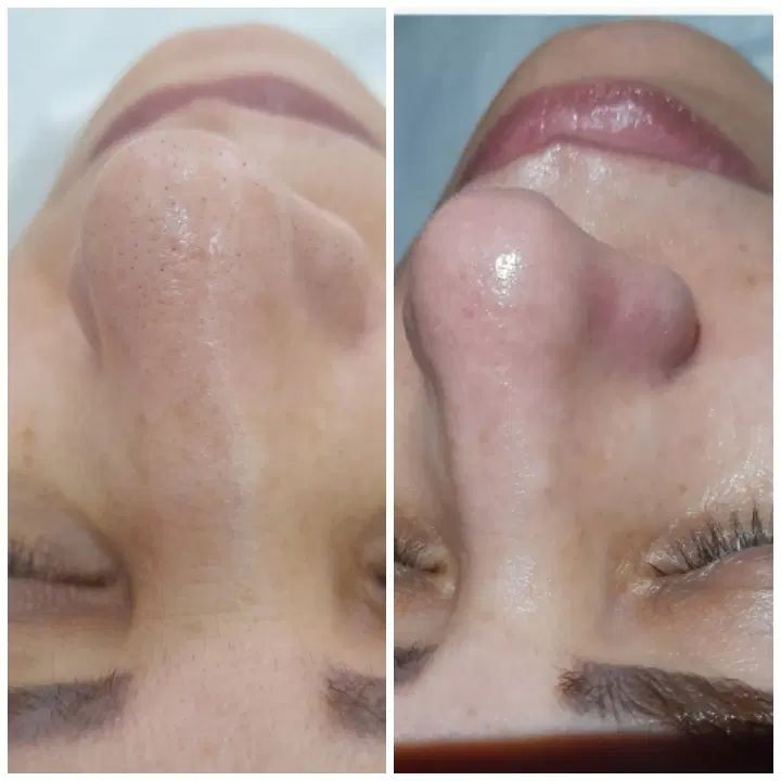 خدمات تخصصی پاکسازی و فیشیال پوست|خدمات آرایشگری و زیبایی|کرج, آق تپه|دیوار