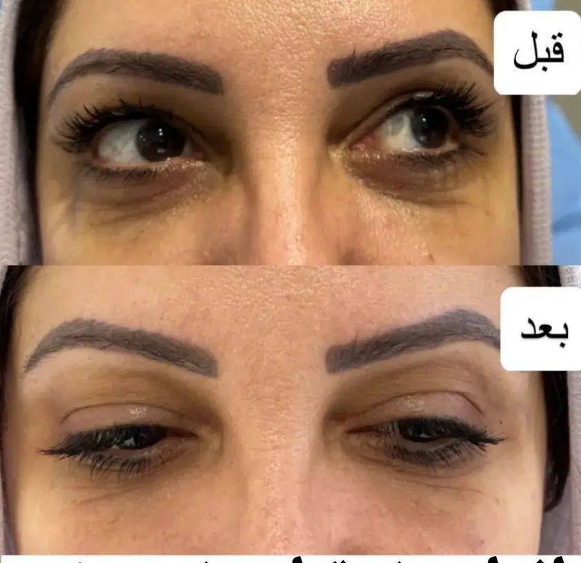 ژل وبوتاکس نخ فیلربادی توسط پزشک|خدمات آرایشگری و زیبایی|تهران, جمهوری|دیوار