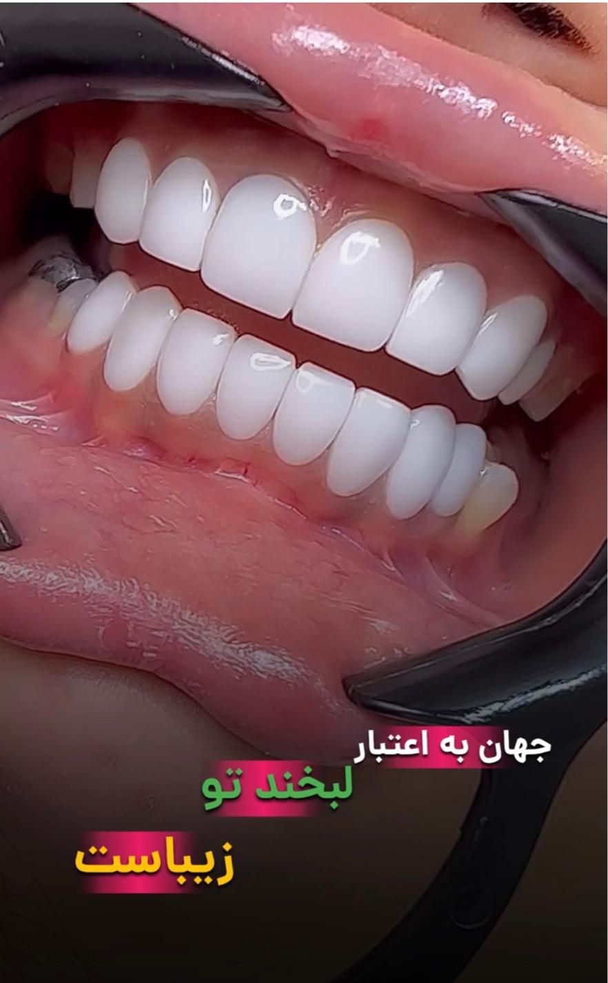 کامپوزیت دندان ،لمینت،بلیچینگ (آف بهاری)|خدمات آرایشگری و زیبایی|اصفهان, خانه اصفهان|دیوار