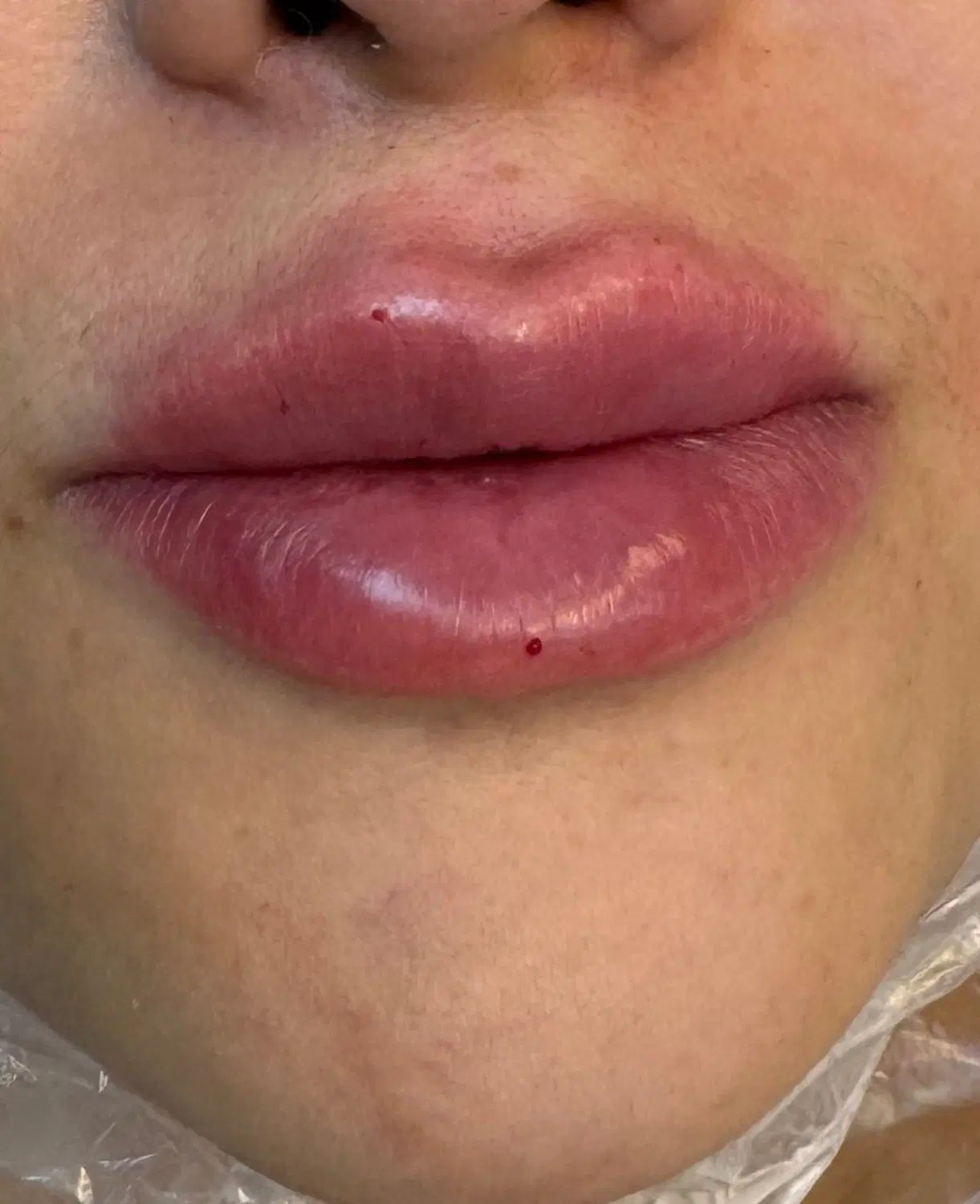 تزریق فیلر لب چانه زاویه فک گونه شقیقه بوتاکس|خدمات آرایشگری و زیبایی|قزوین, |دیوار