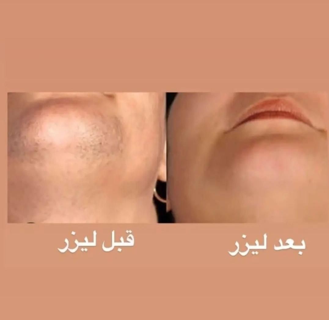 لیزرموهای زائدبادستگاه آلمانی+فیلر+بوتاکس+مزوتراپی|خدمات آرایشگری و زیبایی|کرمان, |دیوار