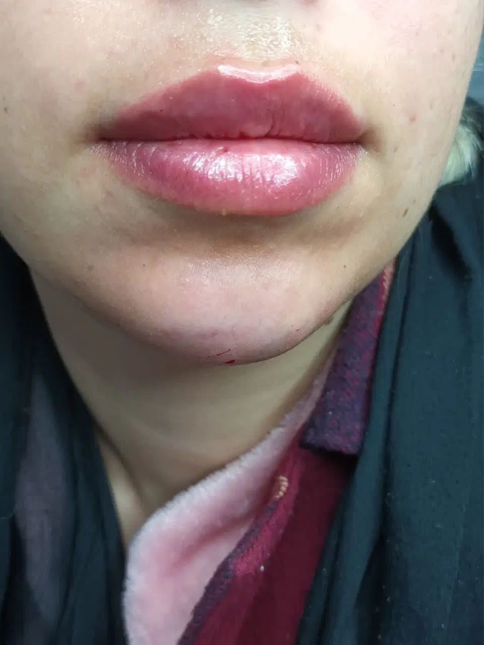 ژل بوتاکس زیبایی بینی لیفت صورت و بدن|خدمات آرایشگری و زیبایی|مشهد, هفت تیر (آب و برق)|دیوار