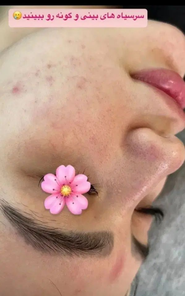 آف باورنکردنی فیشیال فوق پیشرفته اولین‌باردرایذه|خدمات آرایشگری و زیبایی|ایذه, |دیوار