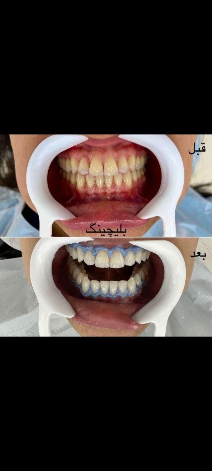 کامپوزیت زیبایی دندان، لمینت، روکش  زیرکونیا|خدمات آرایشگری و زیبایی|کرمانشاه, |دیوار