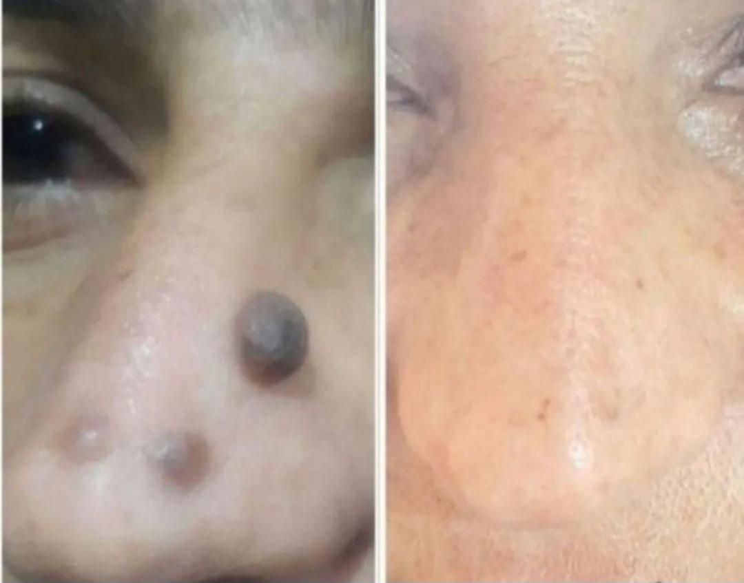 برداشتن انواع خال وزیگل با دستگاه لیزر پیشرفته|خدمات آرایشگری و زیبایی|ارومیه, |دیوار