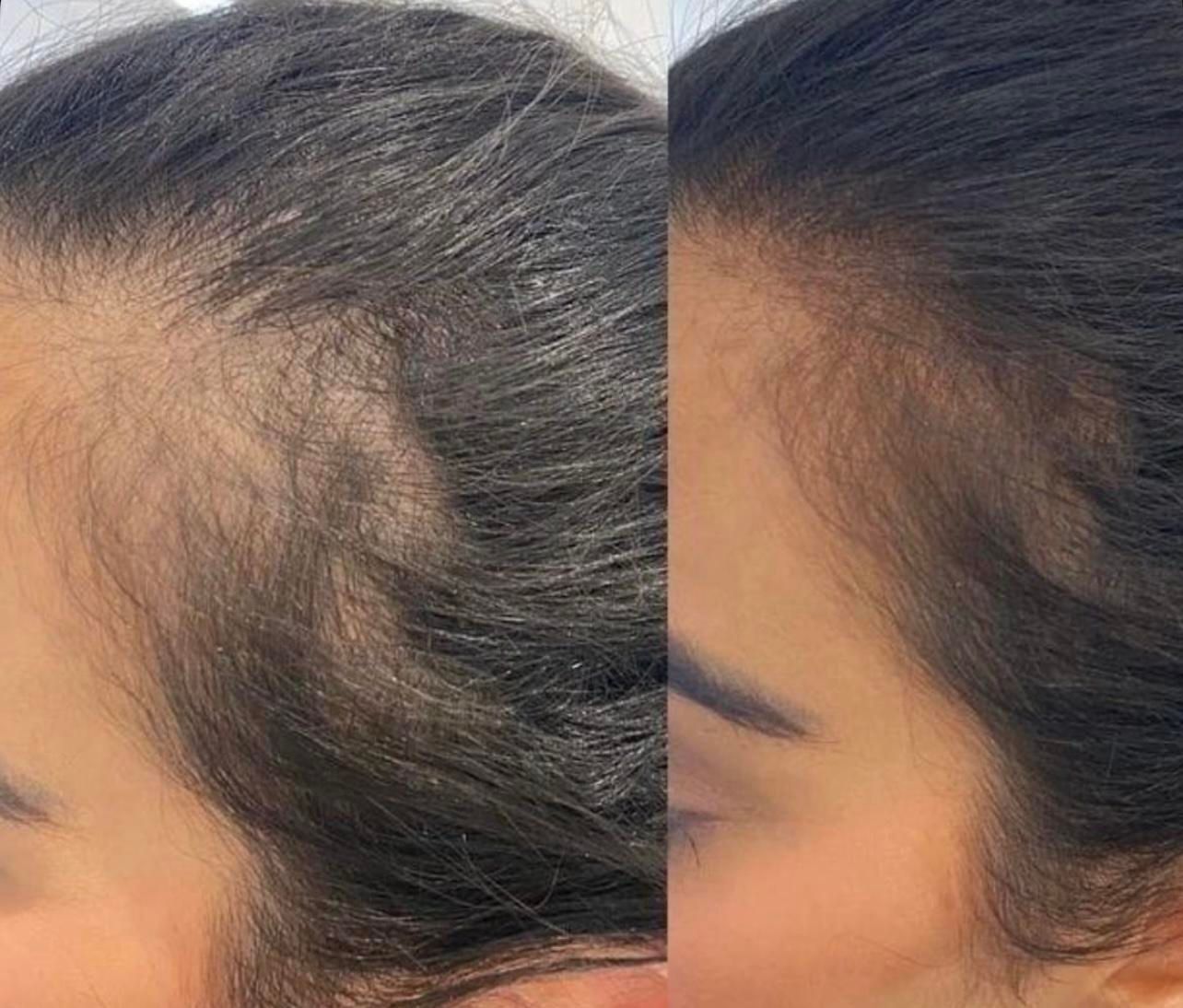 آفر20 درصد درمان قطعی ریزش مو و رویش بدون بازگشت|خدمات آرایشگری و زیبایی|مشهد, کوثر|دیوار