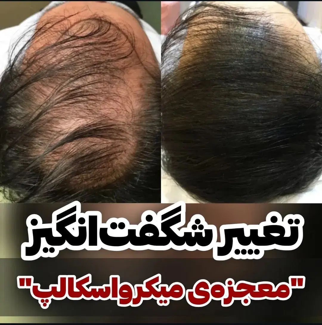 میکرو اسکالپ پوشش کم‌پشتی مو با رنگدانه|خدمات آرایشگری و زیبایی|تهران, حر|دیوار