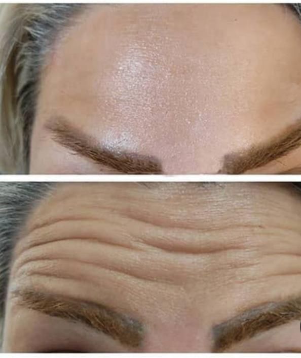 تزریق بوتاکس و ژل در کلینیک(توسط پزشک،)|خدمات آرایشگری و زیبایی|مشهد, هفت تیر (آب و برق)|دیوار